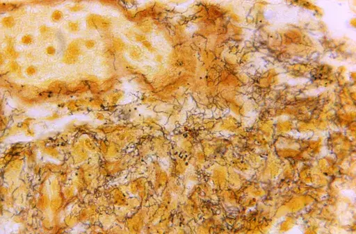 This 1966 microscope photo made available by the Centers for Disease Control and Prevention shows a tissue sample with the presence of numerous, corkscrew-shaped, darkly-stained, Treponema pallidum spirochetes, the bacterium responsible for causing syphilis. The U.S. syphilis epidemic continues to worsen, according to a new government report released Tuesday, Jan. 30, 2024, that also contains some unexpected good news — the rate of new gonorrhea cases has fallen for the first time in a decade.
