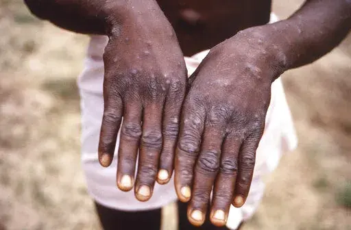This 1997 image provided by the CDC during an investigation into an outbreak of monkeypox, which took place in the Democratic Republic of the Congo (DRC), formerly Zaire, and depicts the dorsal surfaces of the hands of a monkeypox case patient, who was displaying the appearance of the characteristic rash during its recuperative stage. The World Health Organization is convening its emergency committee  on Thursday, July 21, 2022 to consider for the second time within weeks whether the expanding o